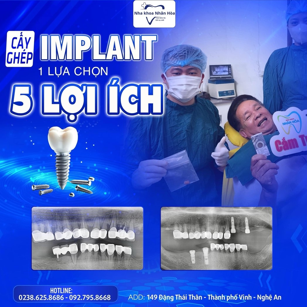 Cấy gh&eacute;p Implant