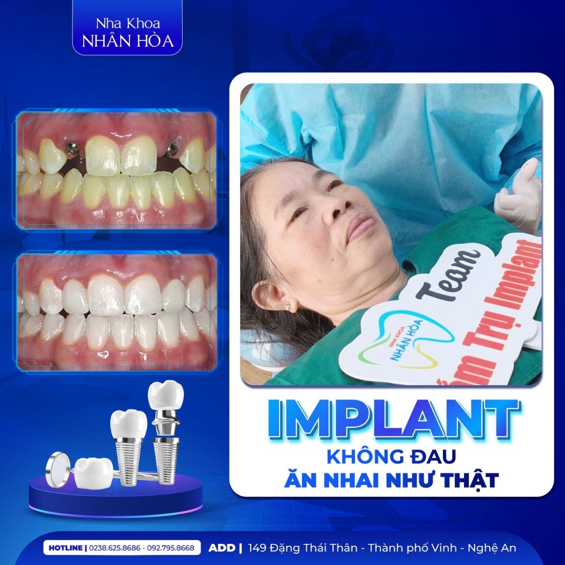 Cấy gh&eacute;p Implant