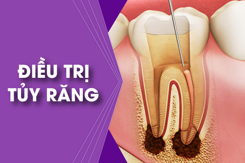 Điều trị tủy răng